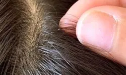 ترفندهایی برای خلاصی کودک از شپش