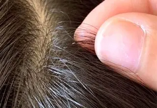 ترفندهایی برای خلاصی کودک از شپش