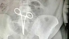 پنس جامانده در شکم مرد جوان، جان او را گرفت