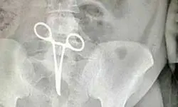 پنس جامانده در شکم مرد جوان، جان او را گرفت