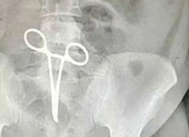 پنس جامانده در شکم مرد جوان، جان او را گرفت