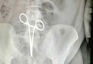 پنس جامانده در شکم مرد جوان، جان او را گرفت