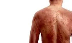 بیماری ترانه علیدوستی چیست؟