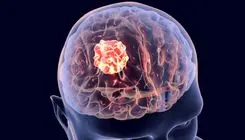 چه کسانی بیشتر در معرض خطر تومورهای مغزی هستند؟