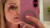حمله یک پرنده به خانم خبرنگار در پخش زنده