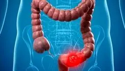 چه عواملی سبب بروز سرطان معده روده می‌شود؟