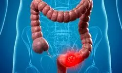 چه عواملی سبب بروز سرطان معده روده می‌شود؟