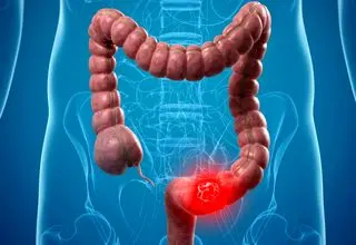 چه عواملی سبب بروز سرطان معده روده می‌شود؟