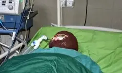 اسیدپاشی هولناک روی پدر و دختر