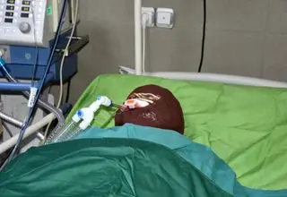 اسیدپاشی هولناک روی پدر و دختر