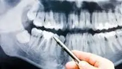 خطرات جرم دندان برای استخوان فک و لثه