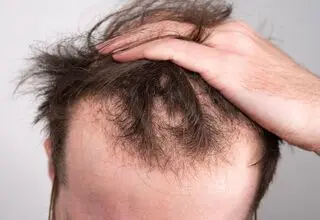 خطر ریزش مو در کمین کارکنان شیفت شب!