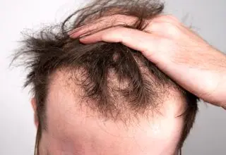 خطر ریزش مو در کمین کارکنان شیفت شب!